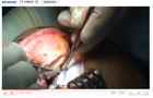 Carticel Autologous Chondrocyte Implantation