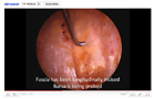 Arthroscopic Hip Bursectomy Surgery