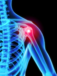Shoulder Replacement Treatment for Pain and Mobility