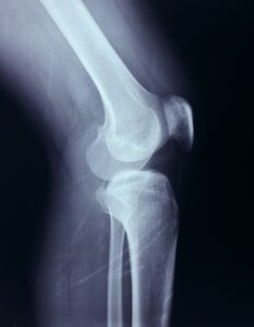 The Advantages of Minimally Invasive Knee Replacement Surgery