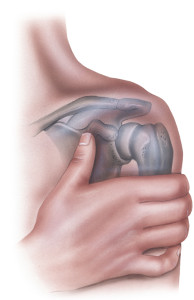 reverse total shoulder replacement