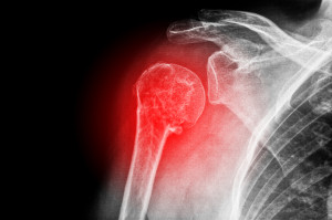 shoulder-fracture-treatment