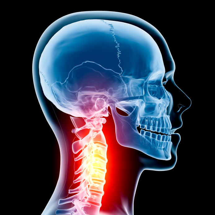 What are the Long-Term Effects of Herniated Disc in the Neck?