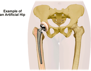 Visit an orthopedic specialist to see if you need an artificial hip. 