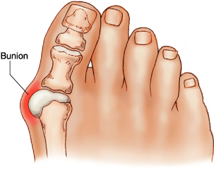 Bunions: Bigger Than They Look