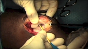 Marc Knee Cartilage Transplant – DeNovo Surgical Technique