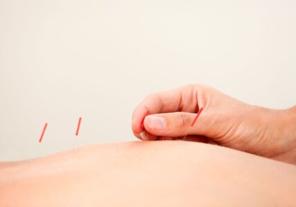 Can Acupuncture Help Treat Your Condition?