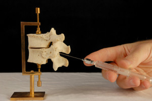 Freedom From Back Pain Through Epidural Steroid Injections