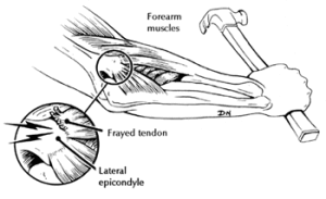 Relief From Tennis Elbow