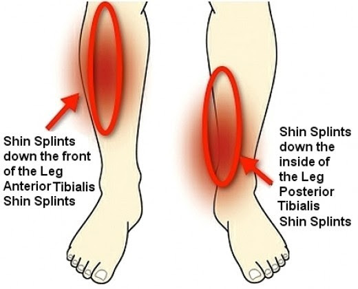 Inner Shin Pain Running