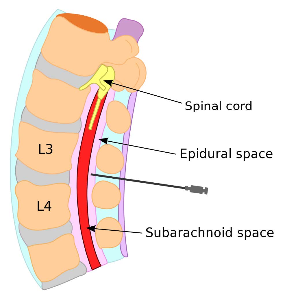 Epidurals Pain Management