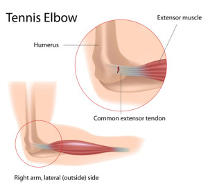 fastpt-tennis-elbow