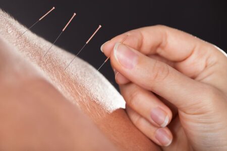 Using Acupuncture To Relieve Pain: A Guide