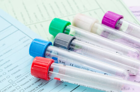 New Blood Test May Detect Early Stages of Osteoarthritis