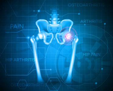 A Guide to Bone Spurs