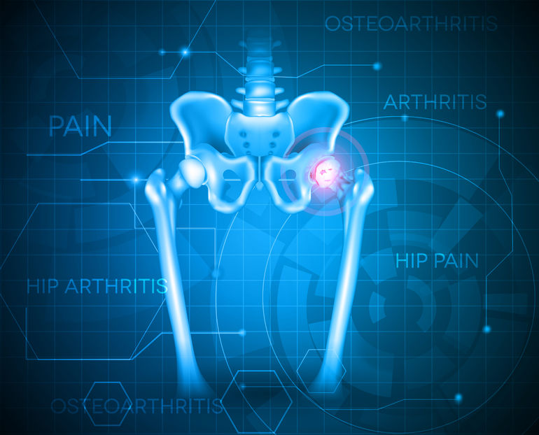 40404432 - human pelvis hip pain, abstract blue background. hip arthritis
