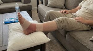 Swollen ankle after a possible broken ankle injury