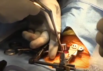 ACDF (Anterior Cervical Discectomy and Fusion) Surgery – Dr. Grigory Goldberg