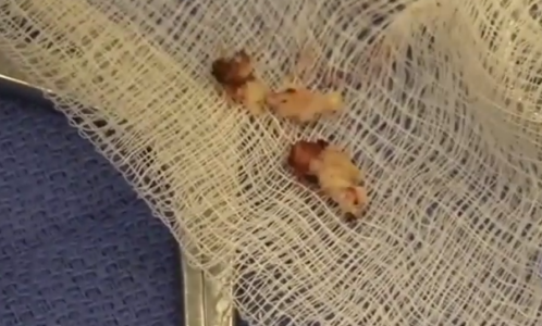 Anterior Cervical Discectomy and Fusion (ACDF) Performed By Dr. Grigory Goldberg