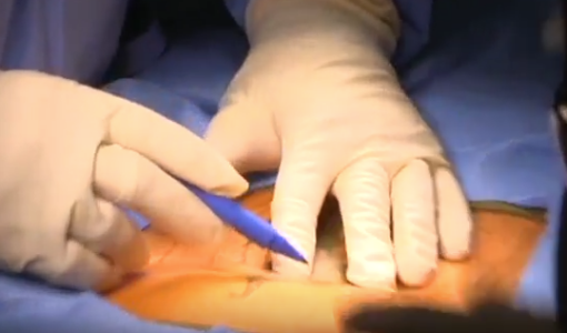 Laminectomy Performed By Dr. Grigory Goldberg