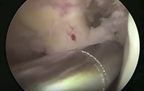 Anatomic ACL Reconstruction