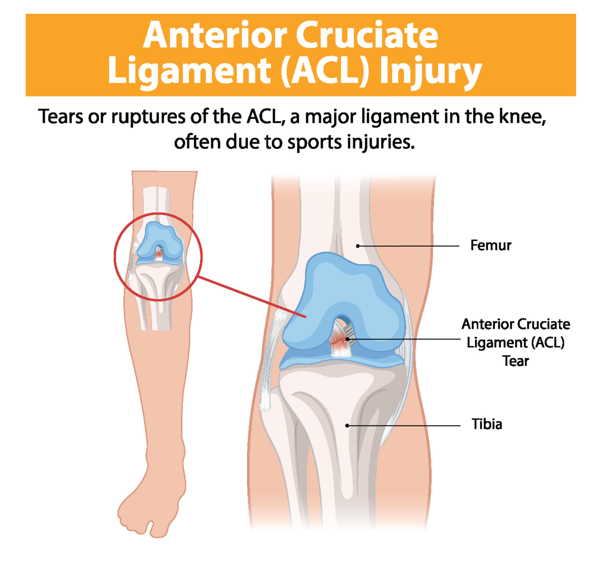 Illustration of ACL tear in the knee joint