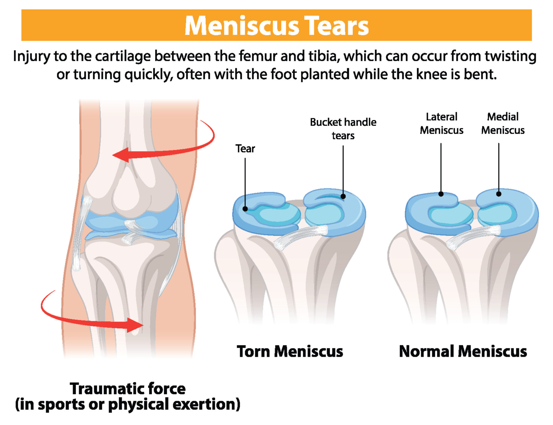 Illustration of normal and torn meniscus in knees