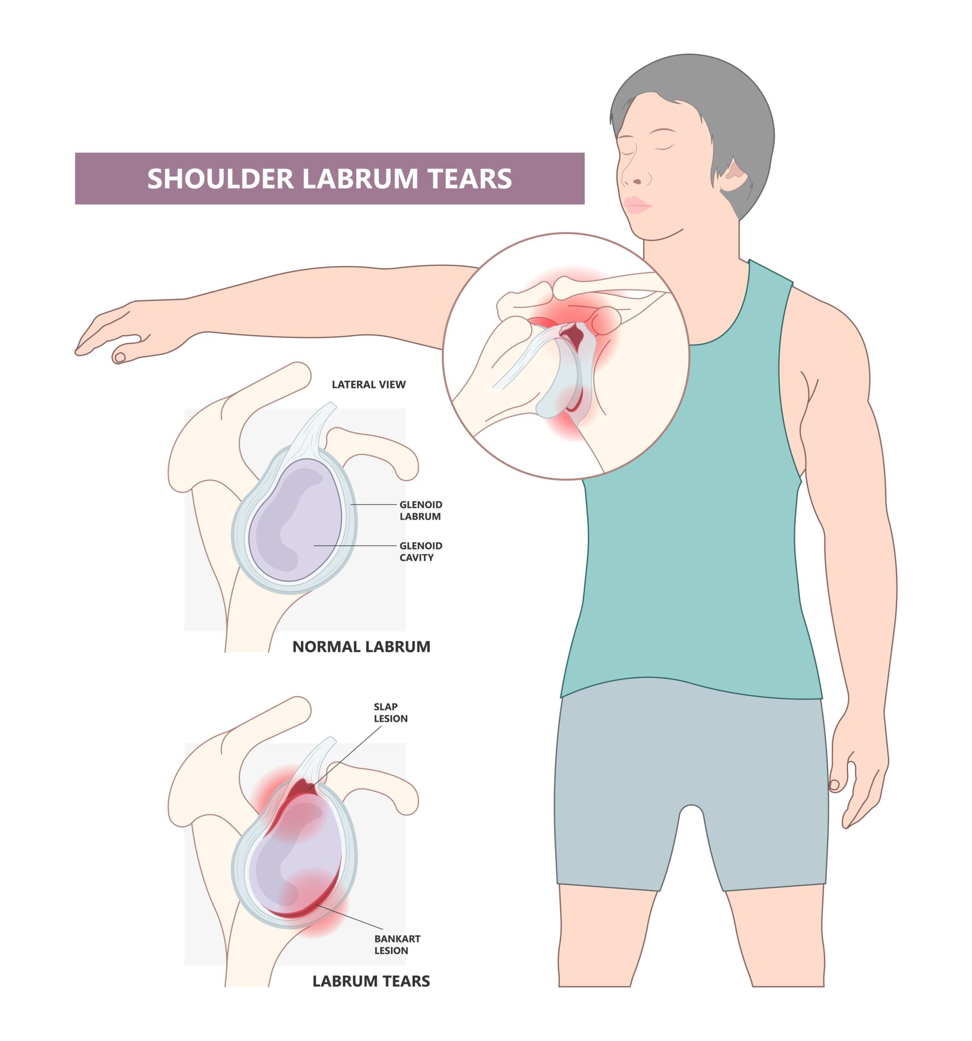 Diagram of Shoulder Instability and Labral Tear