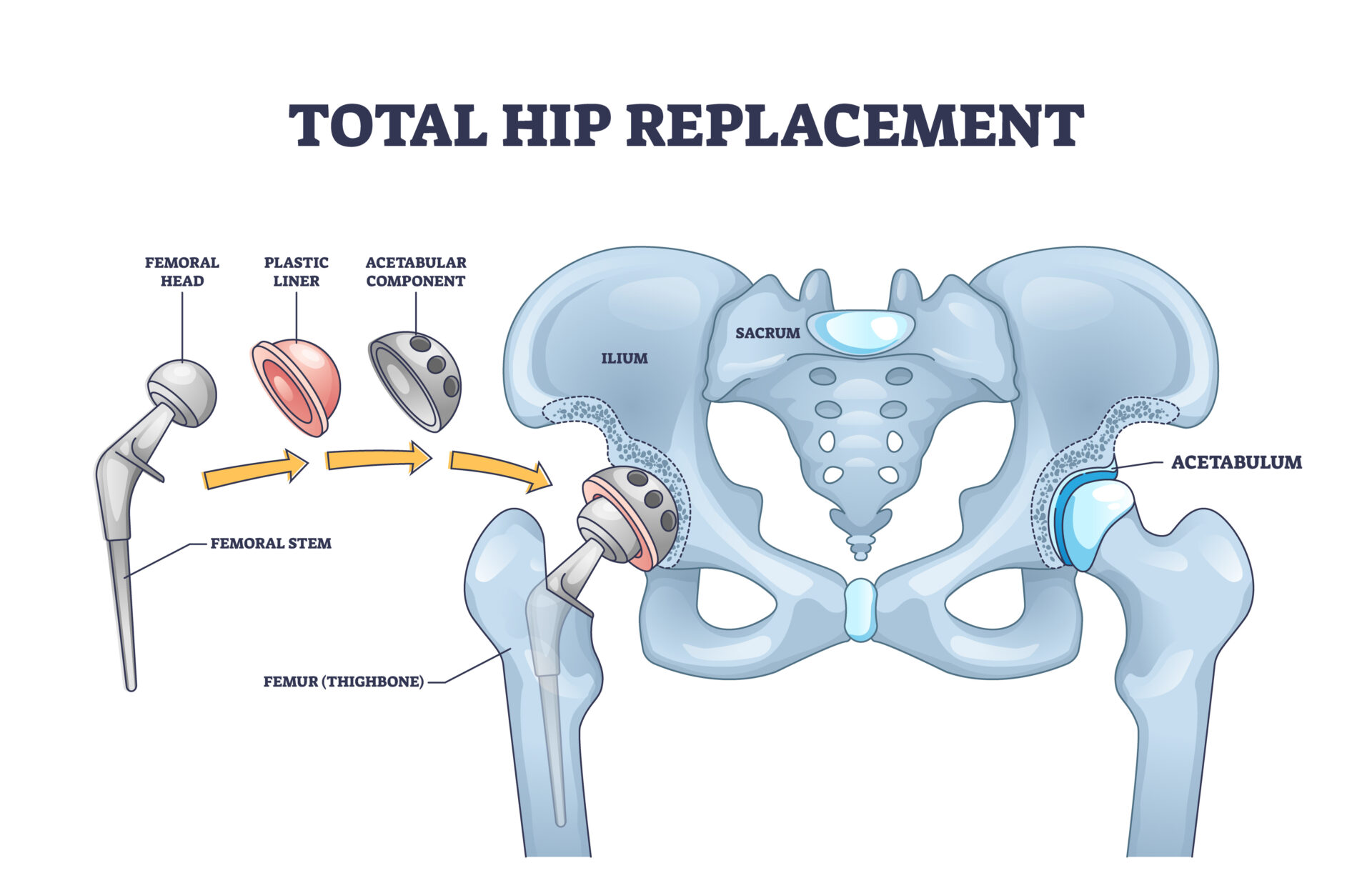 Total hip replacement surgery with anatomical acetabular prosthesis outline diagram. Labeled educational medical operation process description with new artificial bone structure vector illustration.