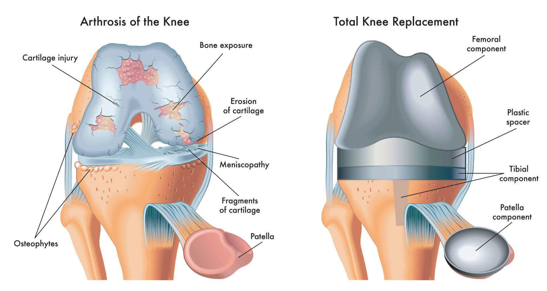 Medical illustration shows an arthrosis of the knee and total knee replacement surgery, with annotations.