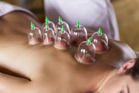 Cupping Therapy at AOSMI: A Time-Tested Technique for Pain Relief