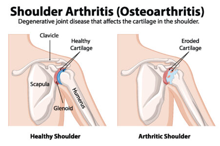 Understanding Arthritis and What You Can Do About It This May