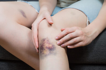 Could it be More Than “Just a Bruise”?