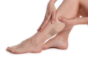 Close-up of swollen and bruised muscle on leg
