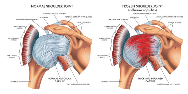 Frozen Shoulder: Why Your Shoulder Feels “Stuck”