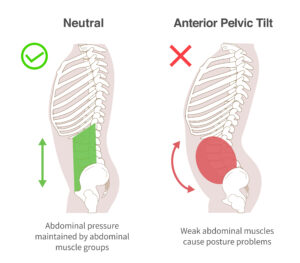 Illustration showing anterior pelvic tilt posture and spinal alignment