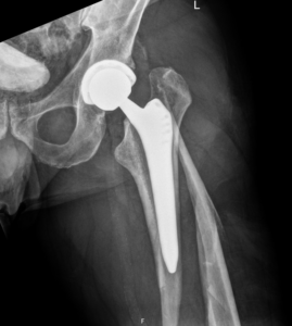 X-ray showing femur fracture around hip replacement implant after traumatic fall