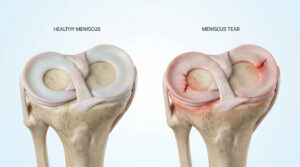 Side-by-side illustration of a healthy knee meniscus and a torn meniscus showing cartilage damage inside the knee joint.