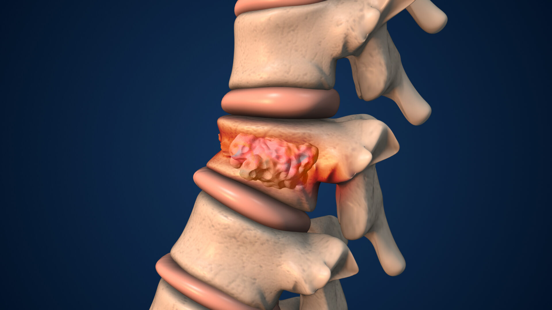 Medical illustration showing a wedge-shaped vertebral compression fracture with reduced vertebral body height.