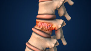 Medical illustration showing a wedge-shaped vertebral compression fracture with reduced vertebral body height.
